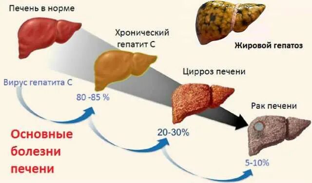 Печень в организме в жире. Жировой гепатоз – жировая болезнь печени. Печень пораженная гепатитом. Печень больная гепатитом.