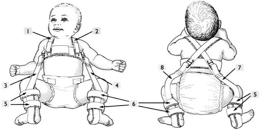 Дисплазия сустава у новорожденного лечение. Стремена Павлика при дисплазии тазобедренных суставов. Дисплазия тазобедренных суставов стремена. Стремена Павлика при дисплазии тазобедренных суставов у детей. Дисплазия тазобедренных суставов стремена Павлика.