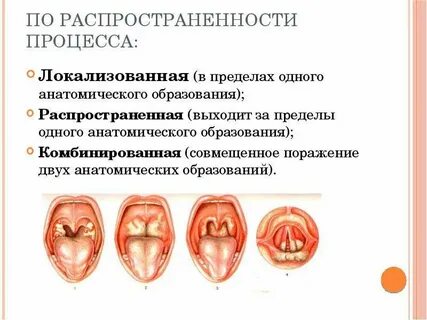 Формы дифтерии