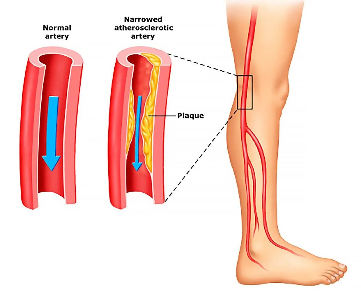 Атеросклеротическое поражение нижних конечностей