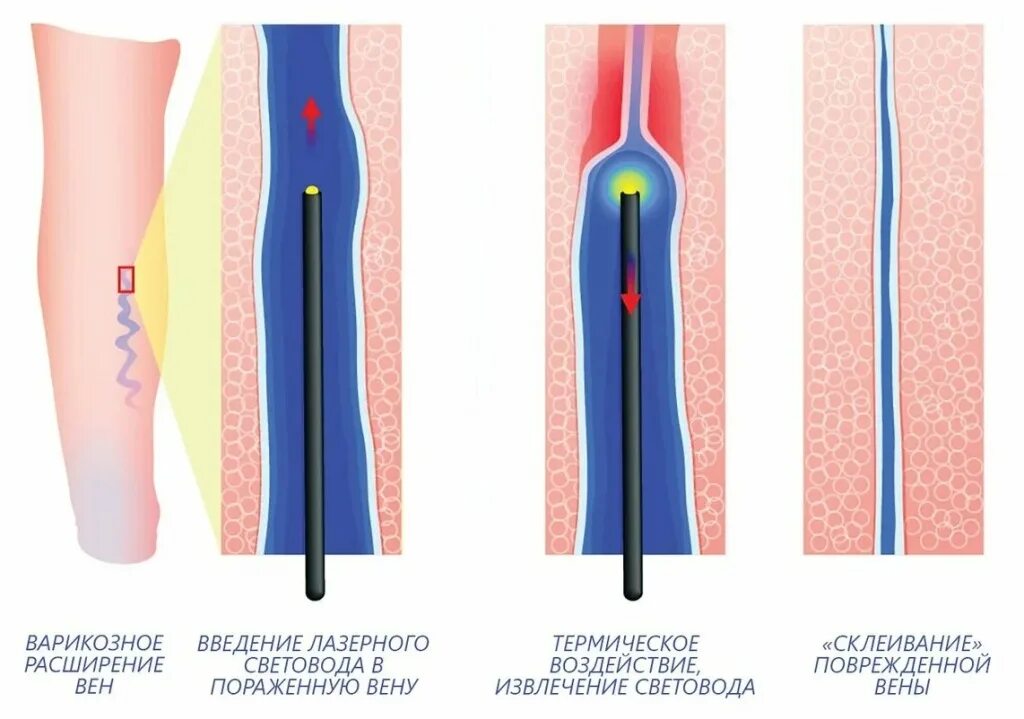 Рекомендации после операции вен. Лазерная коагуляция БПВ. Лазерная облитерация БПВ.