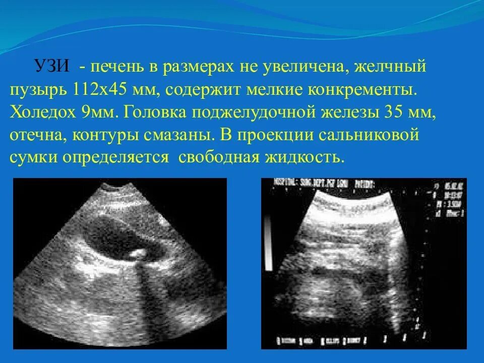 Печень увеличена на узи причины у взрослых. Общий желчный проток норма на узи. узи печени холедох. размеры печени узи норма.