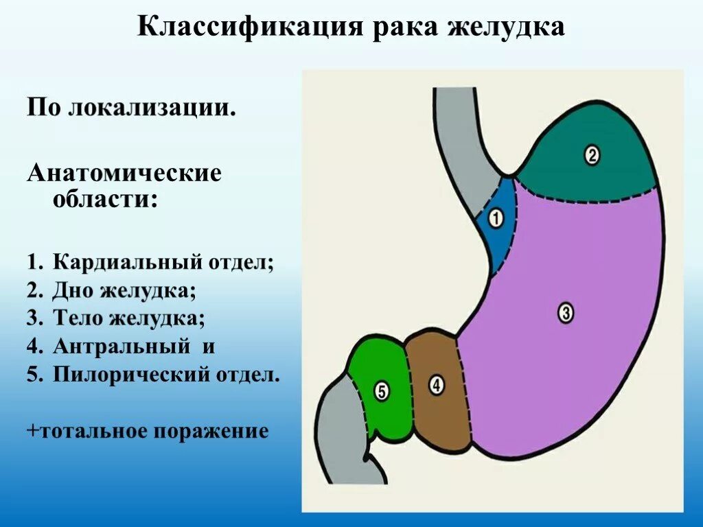 Как определить стадию рака желудка. Локализация опухоли желудка. Опухоль кардиального отдела желудка. Классификация отделов желудка.