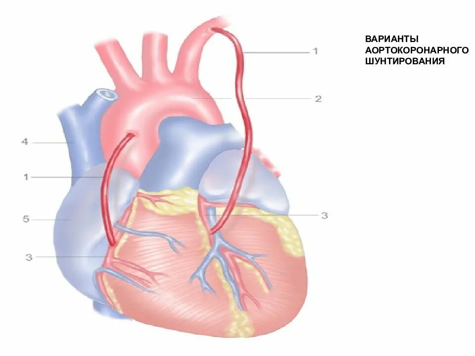 Аортокоронарное шунтирование сердца. Коронарное шунтирование сосудов сердца. Схема операции аортокоронарного шунтирования. Аорта коронарное шунтирование. Что такое шунтирование сердца и сосудов