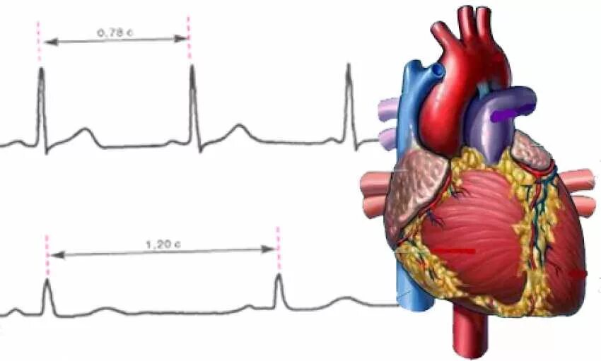 Эпизоды брадикардии. Брадикардия. Брадикардия. Брадикардия причины. Синусовая брадикардия препараты.