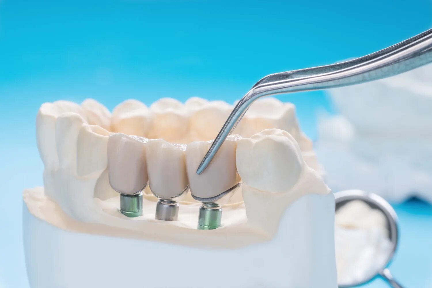 Dental implantation. Имплантация osstem. Dental implantation. Имплант osstem. Дентальный имплантат.