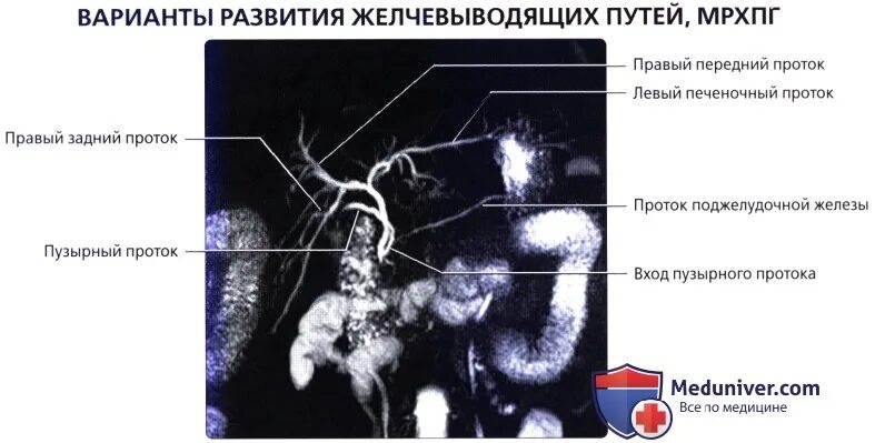 МРХПГ желчных протоков. МРХПГ поджелудочной железы. Магнитно-резонансная холангиопанкреатография (MRCP, МРХПГ). Магнитно-резонансная холангиопанкреатография при ЖКБ.