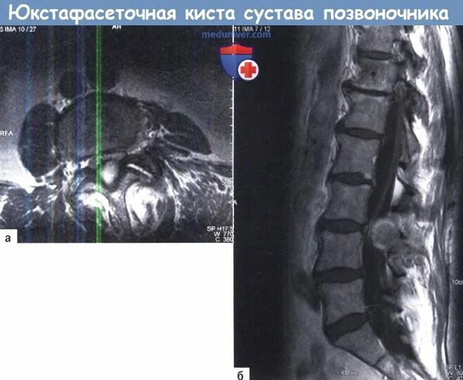 Артроз фасеточных суставов позвоночника. Синовиальная киста позвоночника на мрт. кисты дугоотросчатых суставов позвоночника. фасеточная киста позвоночника.