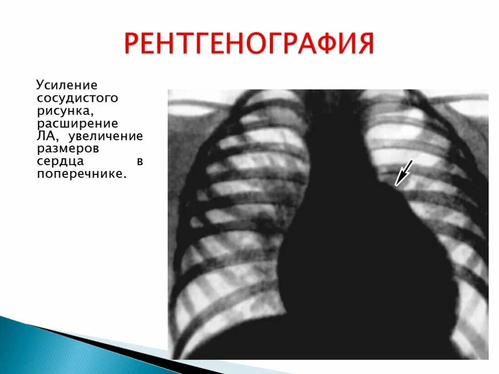 Усиление рисунка