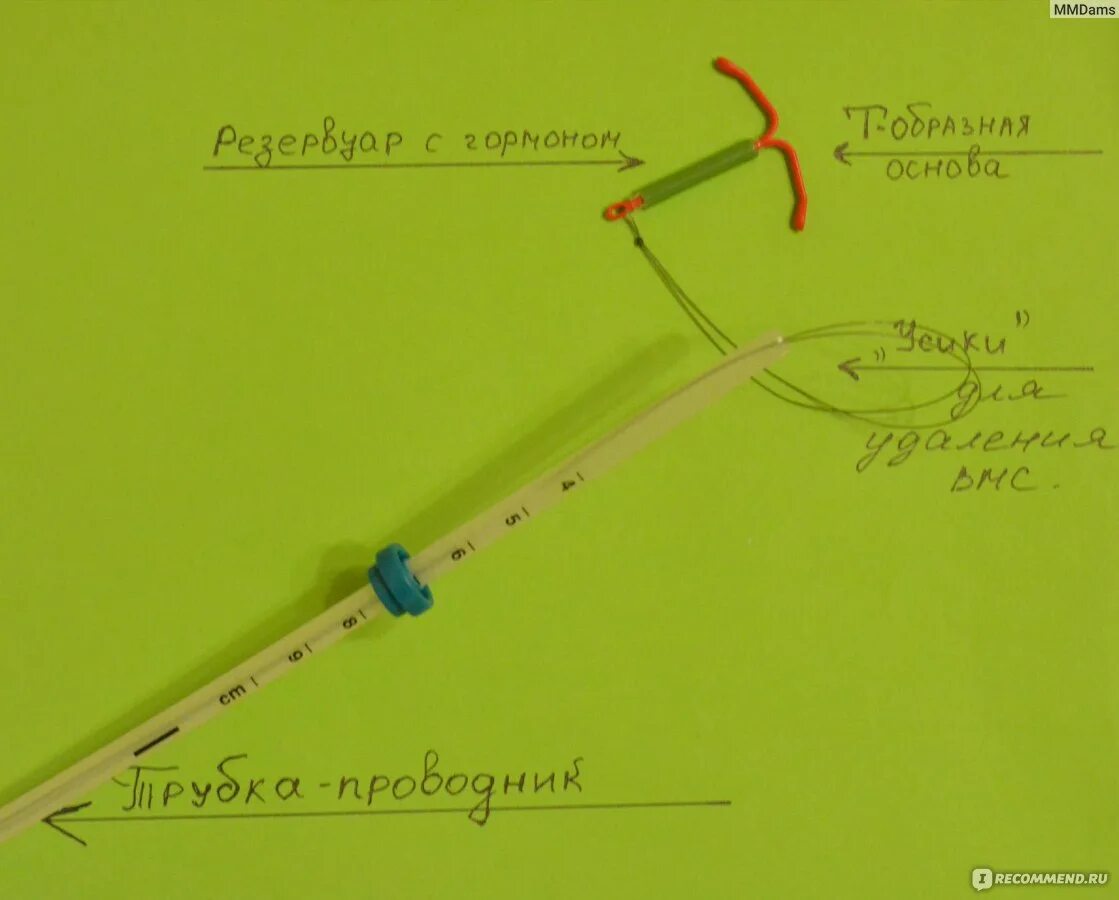 Спираль Мирена. Спираль Мирена установить. Установка спирали Мирена. Длина усиков у спирали Мирена. Крови после установки спирали мирена