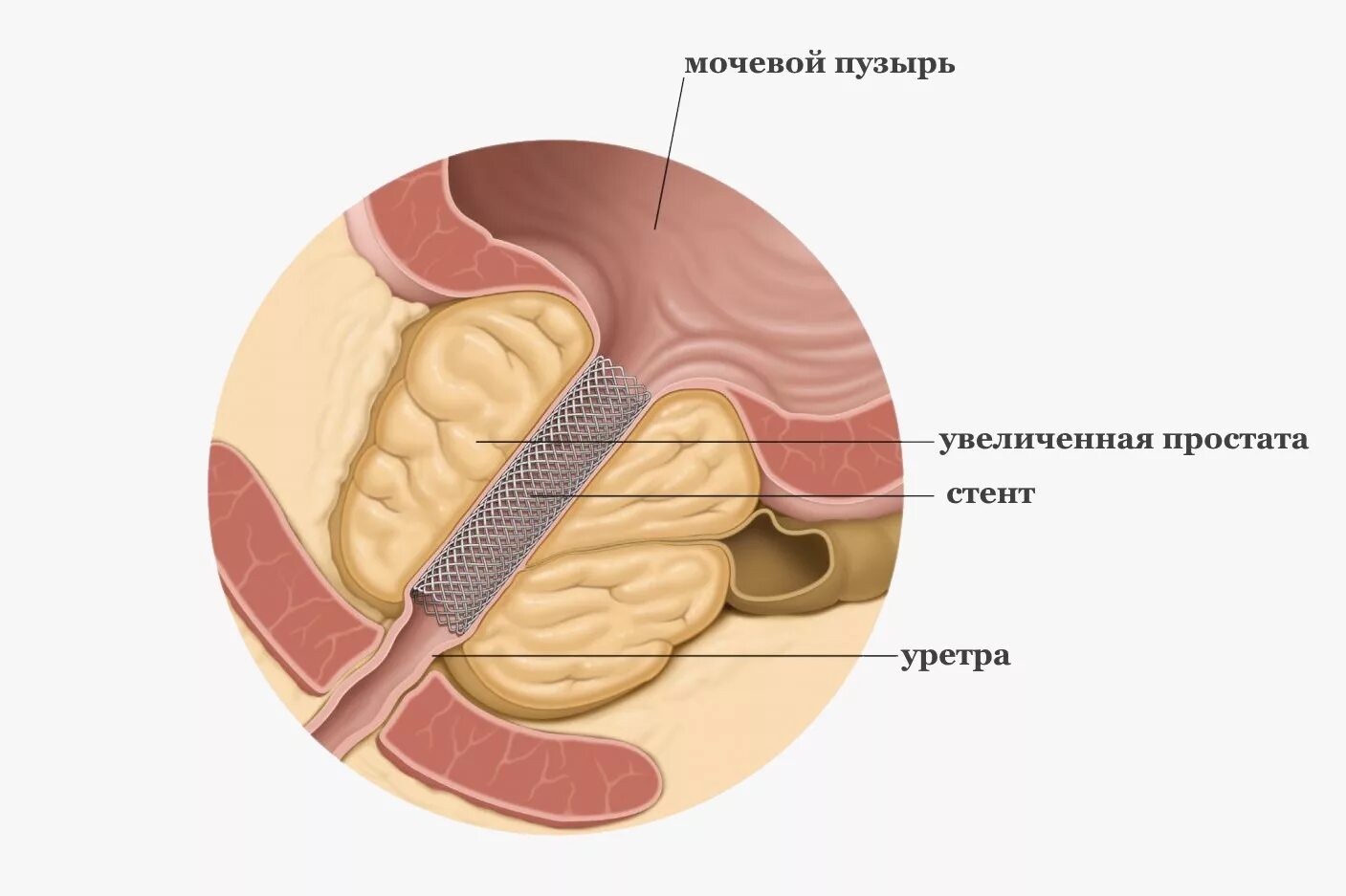 Что есть после удаления простаты