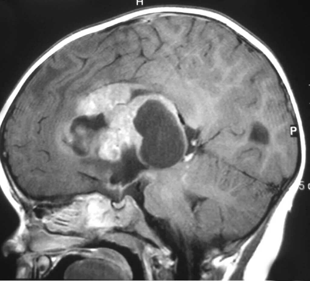 Атипичная тератоид-рабдоидная опухоль. Опухоль головного мозга глиобластома. Опухоль головного мозга отек