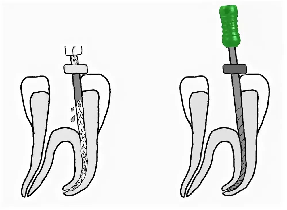 1 корневой канал. Ирригация корневого канала в стоматологии. Активная ирригация корневых каналов. Ирригация корневых каналов схема.