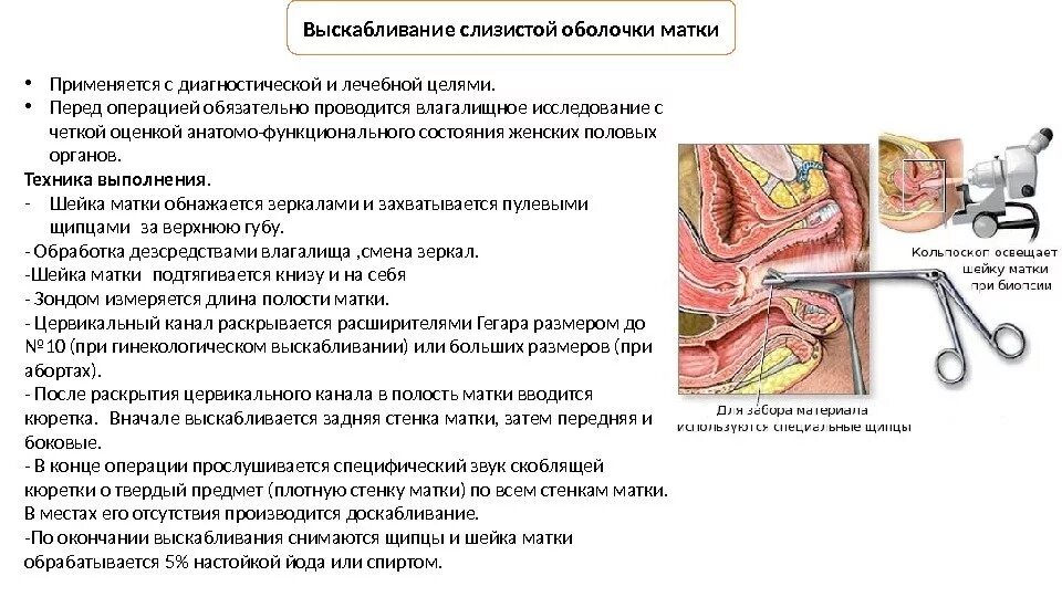 Выскабливание как проводится