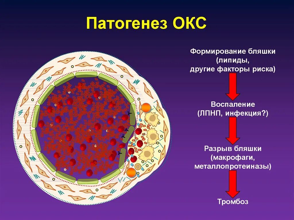 Этиология и патогенез Окс. Острый коронарный синдром патогенез. Окс механизм развития. Механизмы развития острого коронарного синдрома. Есть окс