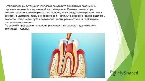 Удаление коронковой пульпы