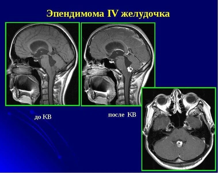 Эпендимома 4 желудочка. Эпендимома 3 желудочка головного мозга. Эпендимома 4 желудочка кт. Эпендимома 4 желудочка. Эпендимома мозжечка мрт.