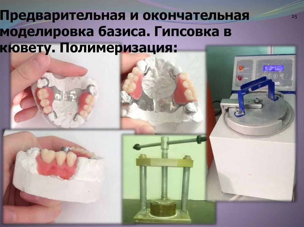 Предварительная моделировка бюгельного протеза. Предварительное моделирование базиса протеза. Предварительное моделирование воскового базиса протеза. Гипсовка бюгельного протеза в кювету.