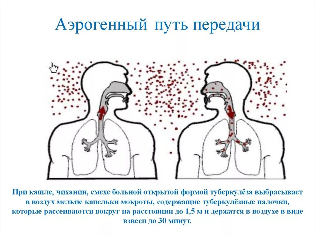 Туберкулез легких передается с мокротой больного человека. Аэрогенный путь передачи туберкулеза. аэрогенные пути передачи инфекции. воздушно капельный механизм заражения. аэрогенный механизм передачи инфекции.