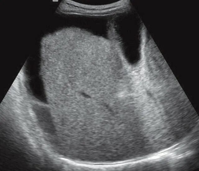 Микронодулярный цирроз печени УЗИ. УЗИ картина цирроза печени Крупноузловой.