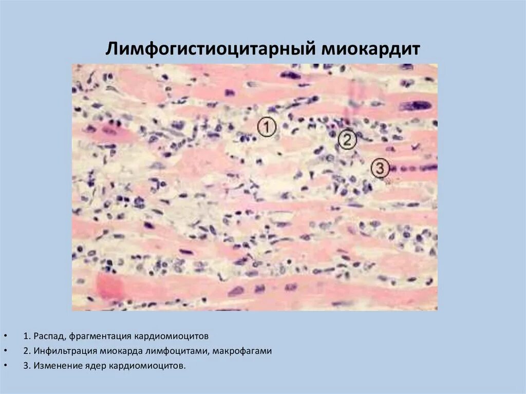 Лимфоидная инфильтрация что это. Лимфогистиоцитарный инфильтрат. Некроз кардиомиоцитов гистология. Идиопатический миокардит Абрамова-Фидлера.