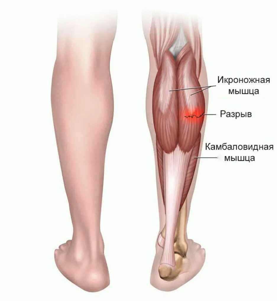 Болит икра на ноге причины и лечение. Икроножная и камбаловидная. Икроножная и камбаловидная мышцы. Растяжение икроножных мышц и сухожилий. Разрыв связки камбаловидной мышцы.