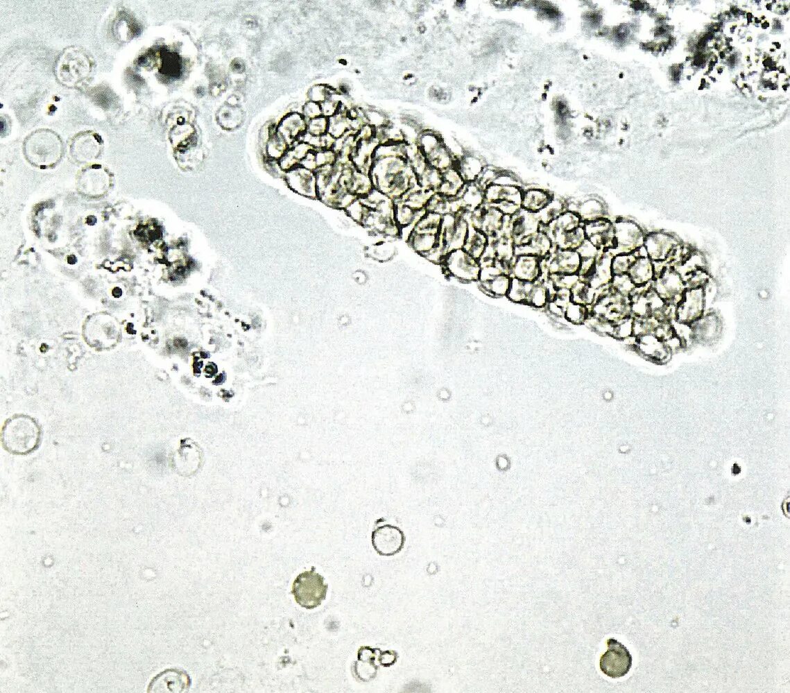 Моча цилиндры гиалиновые повышенные. Гиалиновые цилиндры в моче. Эритроцитарные цилиндры в моче. Гиалиновый цилиндр в моче микроскопия. Зернистый цилиндр микроскопия.