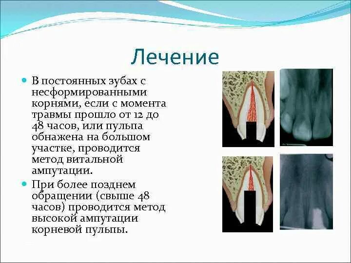 Несформированные корни постоянных зубов