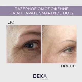 Лазер deka отзывы