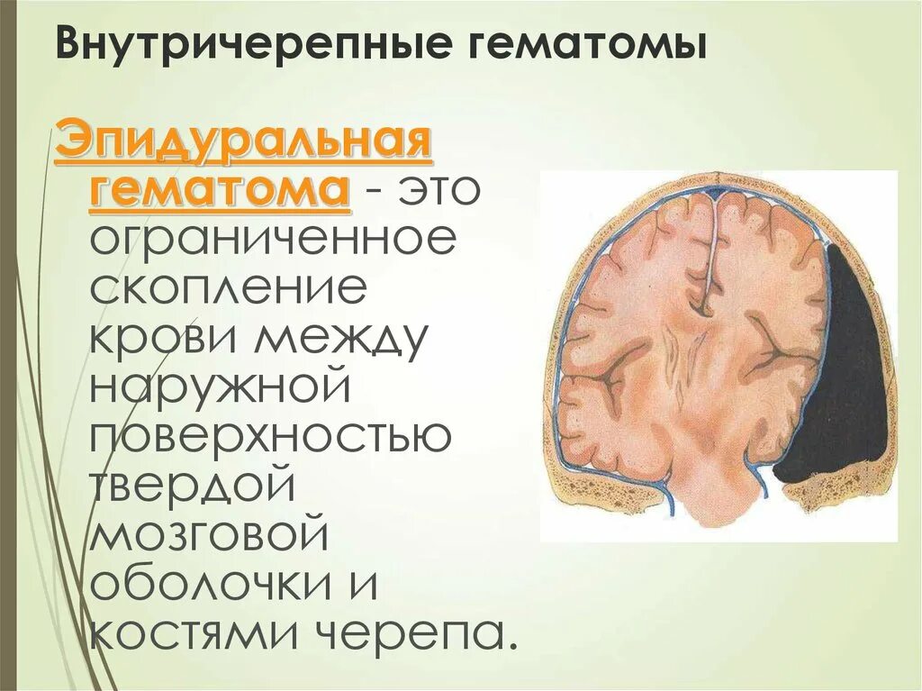 Черепно мозговые гематомы. Внутричерепная гематома. Локализация внутричерепных гематом. Внутричерепная тератома.