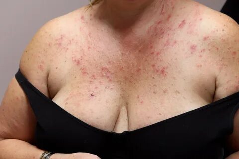 What Causes a Rash on the Breast? 