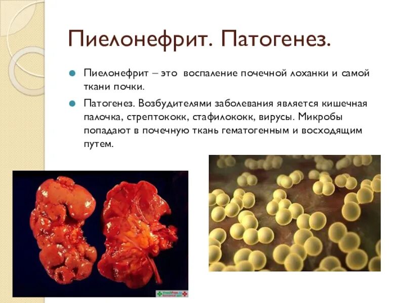 Патогенез хронического пиелонефрита патанатомия. Пиелонефрит почки этиология. Этиопатогенез острого пиелонефрита. Патогенез пиелонефрита кишечной палочки. Тест стрептококк группы а