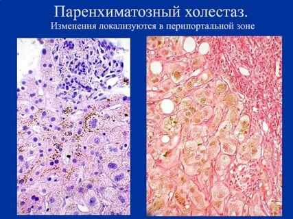 Печень при застойной желтухе микропрепарат