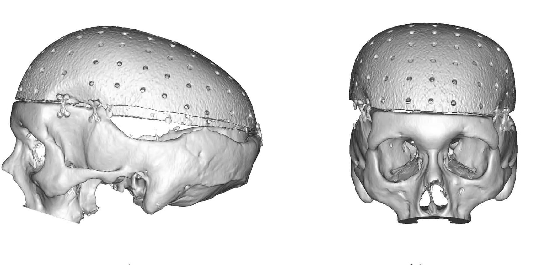 Пластина мозга. Титановая пластина в черепе. Титановые импланты для черепа. Импланты костей черепа.