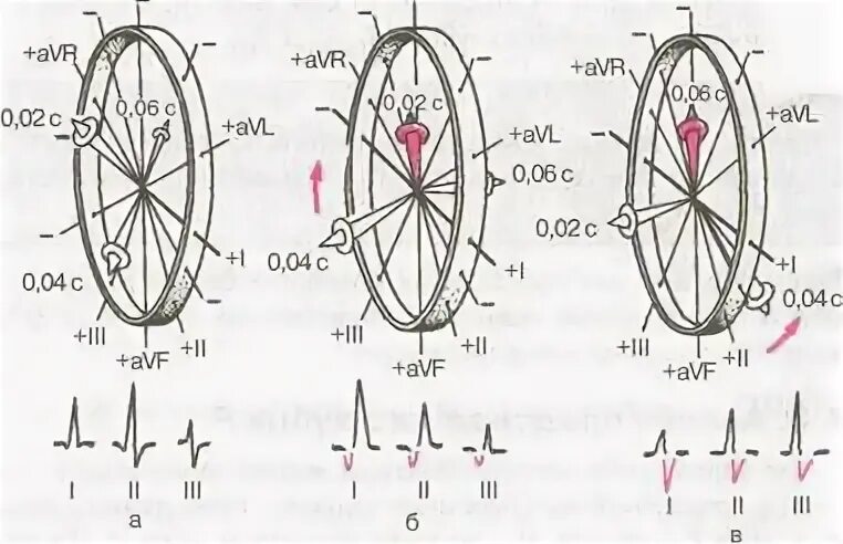Повороты сердца вокруг оси на ЭКГ. Поворот сердца вокруг поперечной оси верхушкой вперед. Поворот сердца верхушкой назад на ЭКГ. Поворот сердца верхушкой кзади на ЭКГ. Поворот правым желудочком вперед