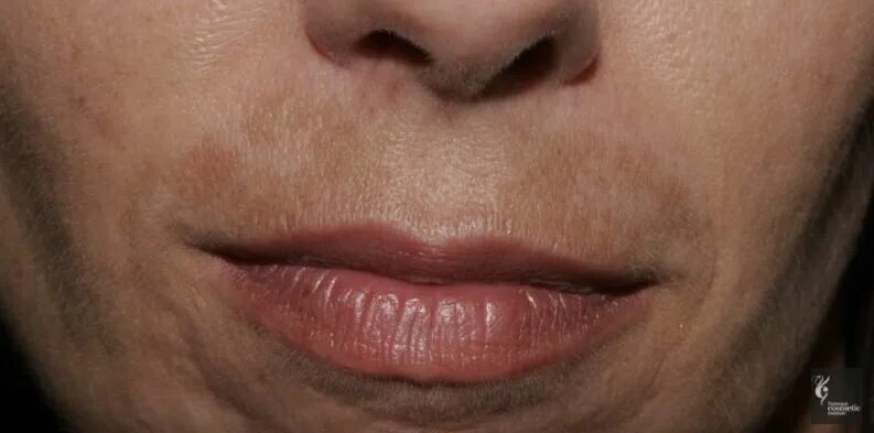 Над верхней губой появились. Мелазма центрофациальная. Пигментные пятна над губой.