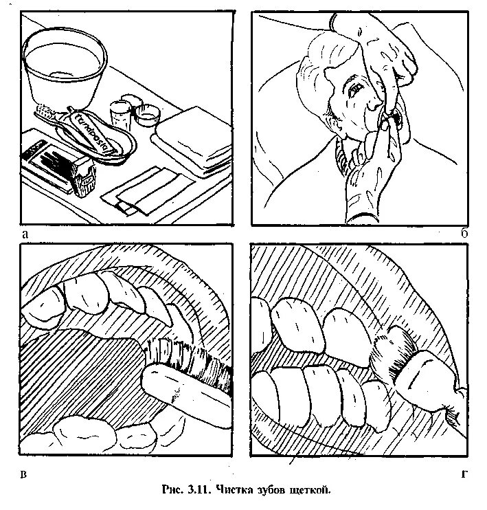 Обработка рта тяжелобольному. Обработка полости рта тяжелобольного пациента алгоритм. Обработка слизистой полости рта алгоритм. Туалет полости рта алгоритм тяжелобольному. Протирание ротовой полости алгоритм.