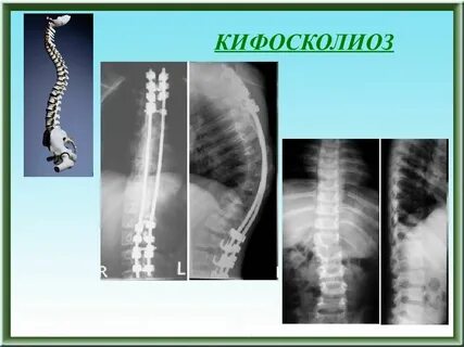 Турнера сколиоз
