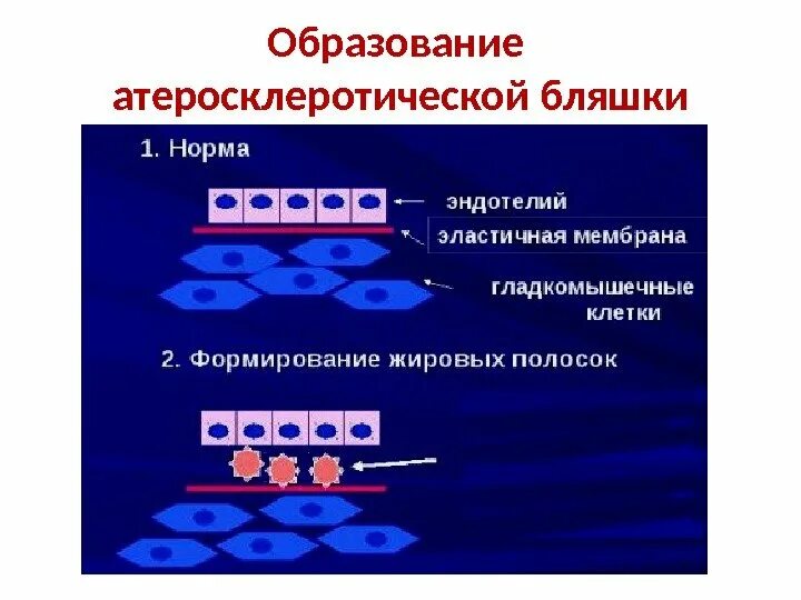 Образование атеросклеротической бляшки. Формирование атеросклеротической бляшки.