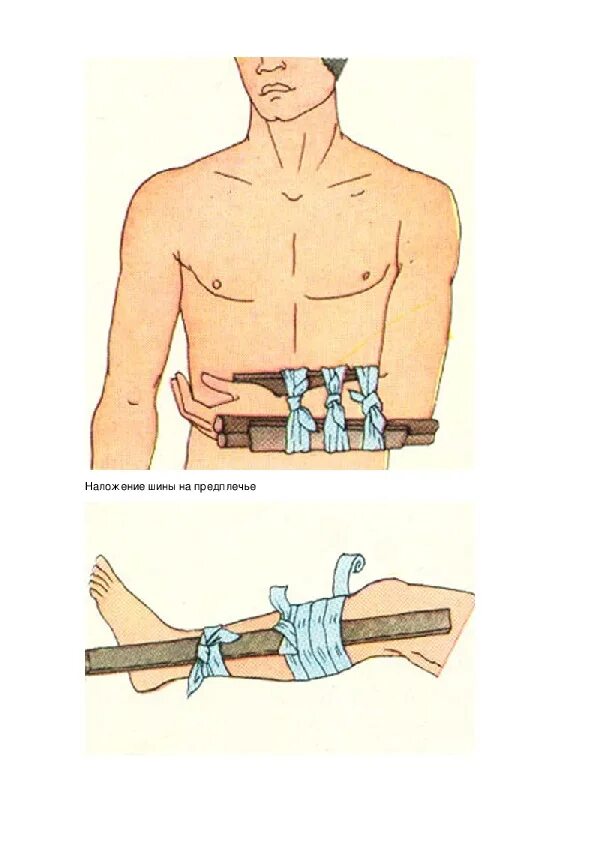 Наложение шин из подручного материала. При открытом переломе накладывают