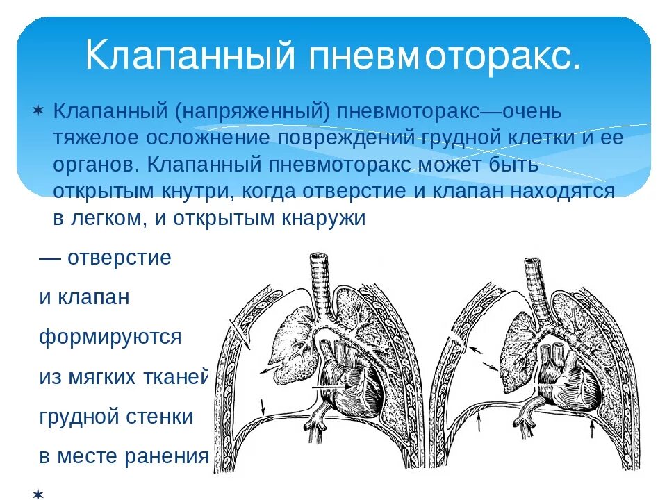 Органы плевральной полости. Открытый пневмоторакс закрытый пневмоторакс клапанный. Наружный клапанный пневмоторакс. Внутренний клапанный пневмоторакс. Пневмоторакс Тотальный субтотальный.