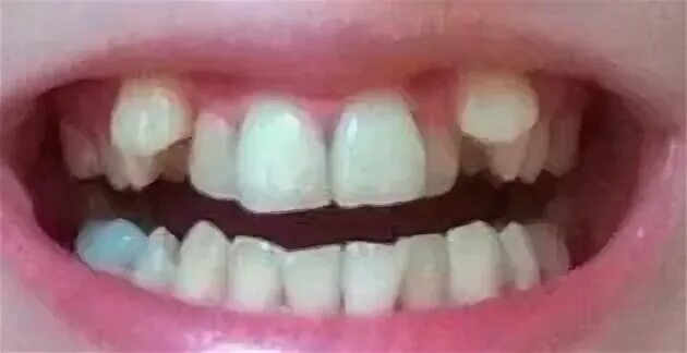 Клыки ра тут поверх зубов. Клык фото зуба
