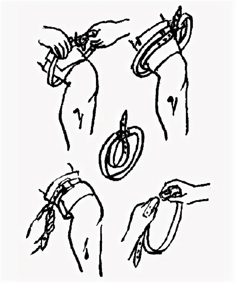 Технику наложения жгута на конечности. Техника наложения кровоостанавливающего жгута на бедро. Техника наложения венозных жгутов на конечности. Технику наложения венозных жгутов. Наложение жгута при кровотечениях алгоритм.
