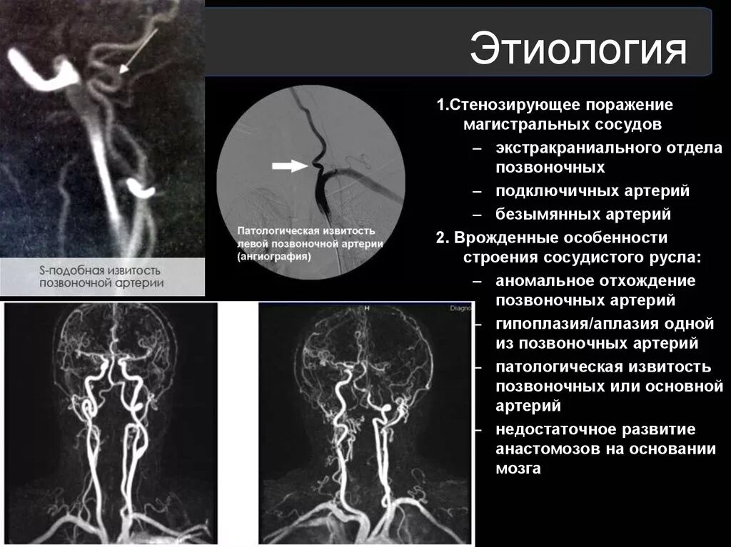 Гипоплазия v4 позвоночной артерии. Гипоплазия v4 сегмента правой позвоночной артерии. Гипоплазия позвоночной артерии мрт. Аплазия позвоночной артерии мрт. Гипоплазия правой артерии мозга