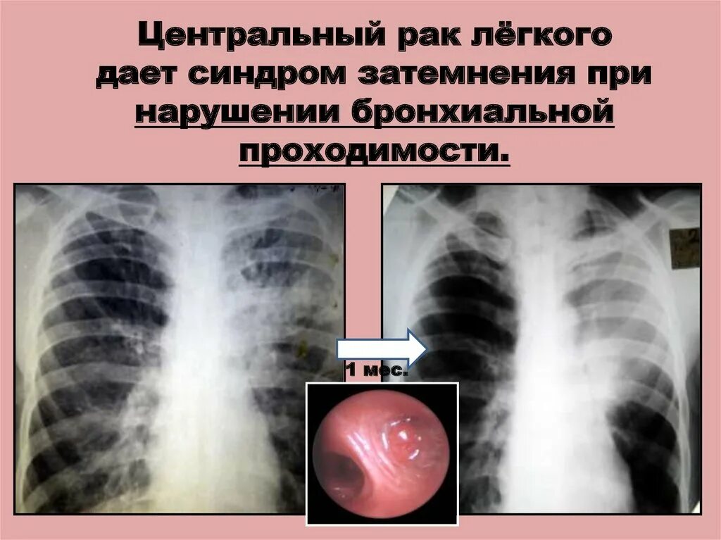 Синдром затемнения легочной ткани. Затемнение легкого на рентгене. Пневмония затемнение в легких. Легко ли обнаружить