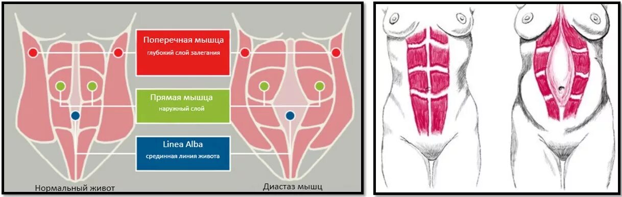 Прямая мышца живота у женщин. Диастаз поперечных мышц. Мышцы пресса анатомия диастаз.