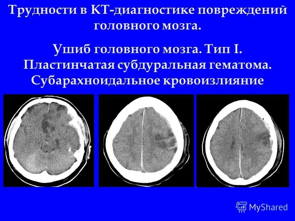 Ушиб головного мозга кт. Пластинчатая субдуральная гематома кт. субдуральная гематома головного мозга кт. субдуральное и субарахноидальное кровоизлияние кт. пластинчатая субдуральная гематома головного мозга.