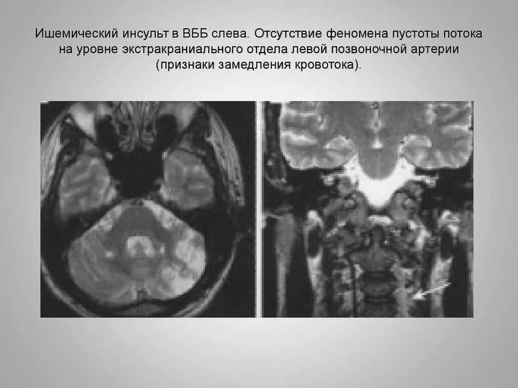 Вертебро базилярная инсульт. Феномен пустоты потока мрт. Ишемический инсульт мрт. Ишемический инсульт в ВББ на кт. Ишемический инсульт вертебро-базилярного бассейна.