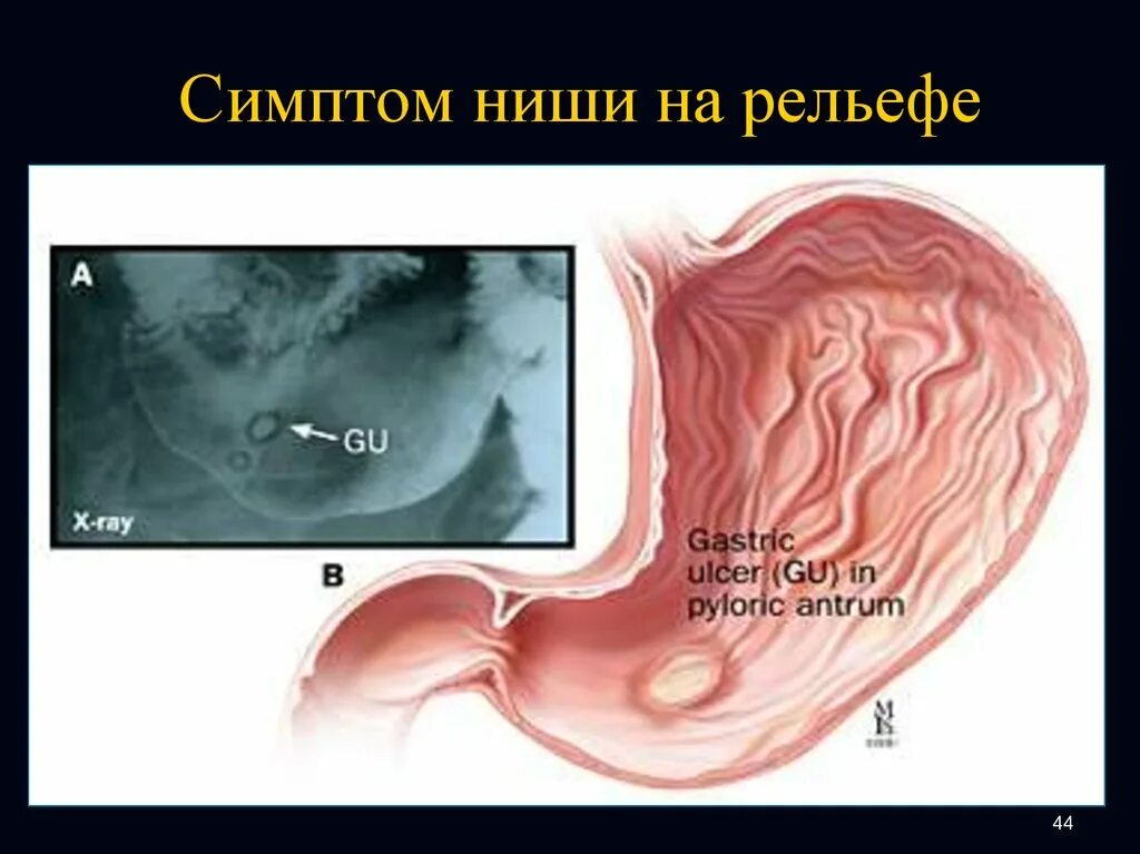 Нормальный пищевод. Рентген язвы желудка симптом ниши. Язва желудка на рельефе.