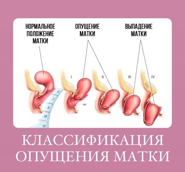 Ощущение выпадение матки как это наглядный пример Опущение матки Arimed